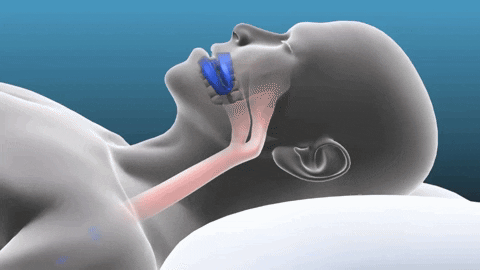 Prosleep - Protector bucal antirronquido